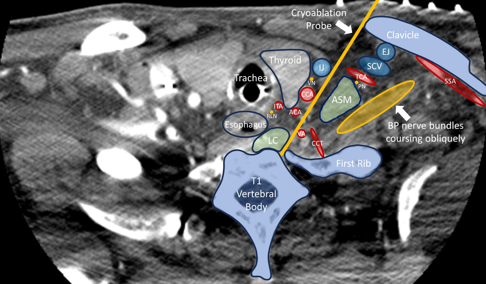Neuromodulation